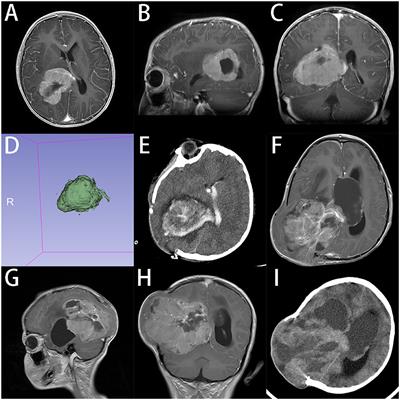 Giant Pediatric Supratentorial Tumor: Clinical Feature and Surgical Strategy